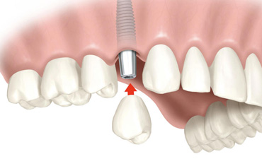 Implantes Dentales